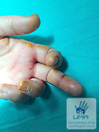 Casos Clinicos de la Unidad de Cirugía de la Mano A Coruña:No se puede flexionar el dedo 3º