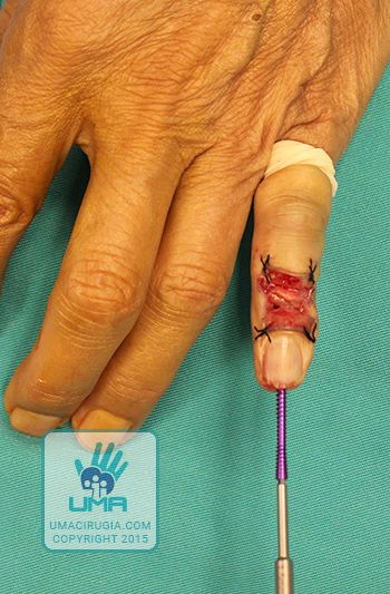 Cirugía de la mano en la Unidad de la Mano de A Coruña: Fijación de tornillo canulado guía AK