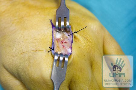 Cirugía de la mano en la Unidad de la Mano de A Coruña:Abordaje dorsal sobre la cicatriz previa